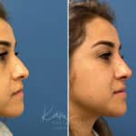 Liquid Rhinoplasty before and after photos in Voorhees, NJ, Patient 1884