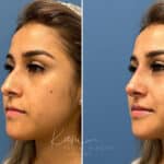 Liquid Rhinoplasty before and after photos in Voorhees, NJ, Patient 1884
