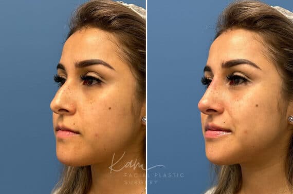 Liquid Rhinoplasty before and after photos in Voorhees, NJ, Patient 1884