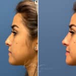 Liquid Rhinoplasty before and after photos in Voorhees, NJ, Patient 1884