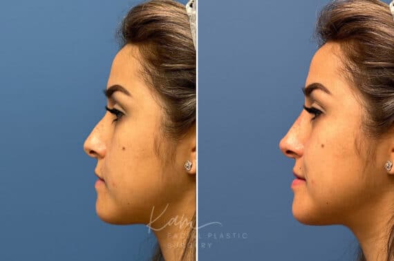 Liquid Rhinoplasty before and after photos in Voorhees, NJ, Patient 1884