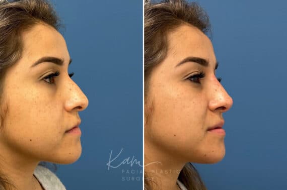 Liquid Rhinoplasty before and after photos in Voorhees, NJ, Patient 1884