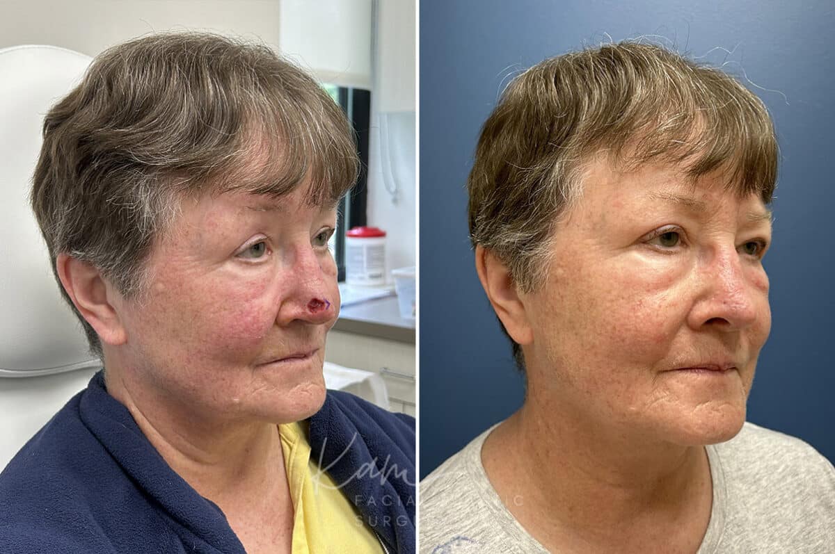 Mohs Reconstruction before and after photos in Voorhees, NJ, Patient 1897