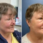 Mohs Reconstruction before and after photos in Voorhees, NJ, Patient 1897