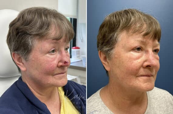 Mohs Reconstruction before and after photos in Voorhees, NJ, Patient 1897