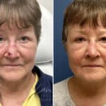 Mohs Reconstruction before and after photos in Voorhees, NJ, Patient 1897