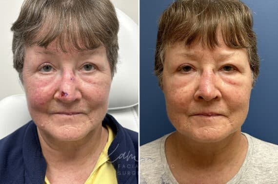 Mohs Reconstruction before and after photos in Voorhees, NJ, Patient 1897