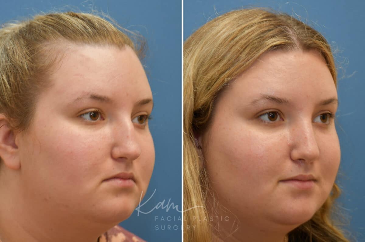 Rhinoplasty before and after photos in Voorhees, NJ, Patient 1905