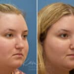 Rhinoplasty before and after photos in Voorhees, NJ, Patient 1905