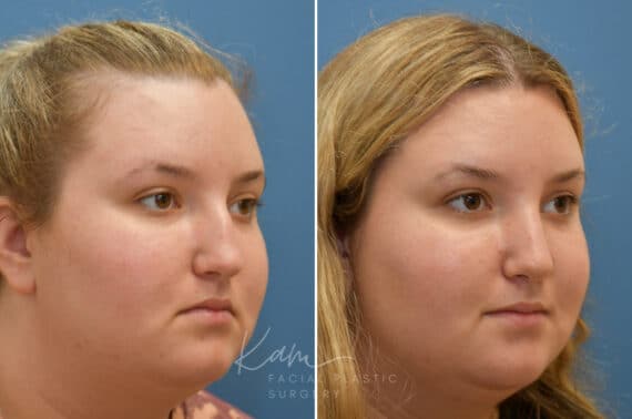 Rhinoplasty before and after photos in Voorhees, NJ, Patient 1905