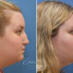 Rhinoplasty before and after photos in Voorhees, NJ, Patient 1905