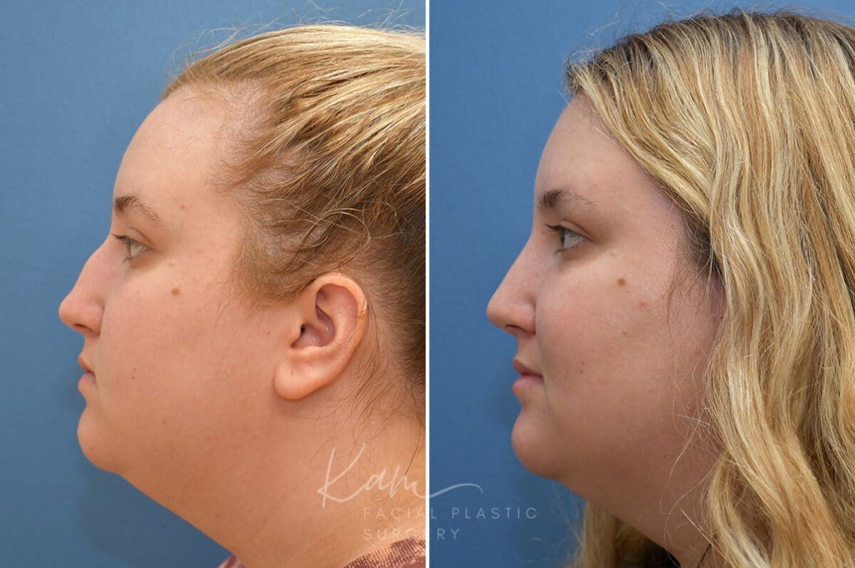 Rhinoplasty before and after photos in Voorhees, NJ, Patient 1905