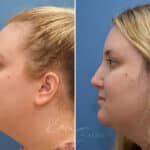 Rhinoplasty before and after photos in Voorhees, NJ, Patient 1905