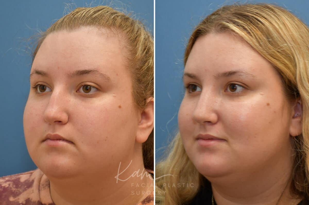 Rhinoplasty before and after photos in Voorhees, NJ, Patient 1905