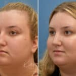 Rhinoplasty before and after photos in Voorhees, NJ, Patient 1905
