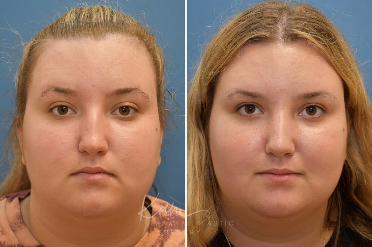 Rhinoplasty before and after photos in Voorhees, NJ, Patient 1905