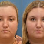 Rhinoplasty before and after photos in Voorhees, NJ, Patient 1905