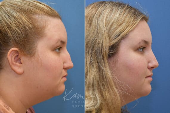 Rhinoplasty before and after photos in Voorhees, NJ, Patient 1905