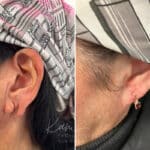 Otoplasty before and after photos in Voorhees, NJ, Patient 1921