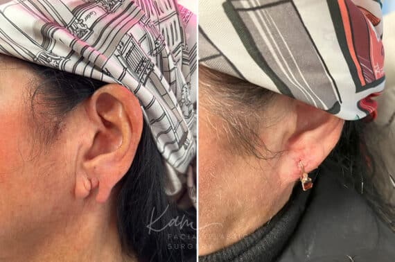 Otoplasty before and after photos in Voorhees, NJ, Patient 1921