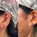 Otoplasty before and after photos in Voorhees, NJ, Patient 1921