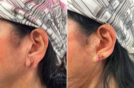 Otoplasty before and after photos in Voorhees, NJ, Patient 1921