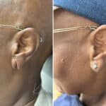 Otoplasty before and after photos in Voorhees, NJ, Patient 1926