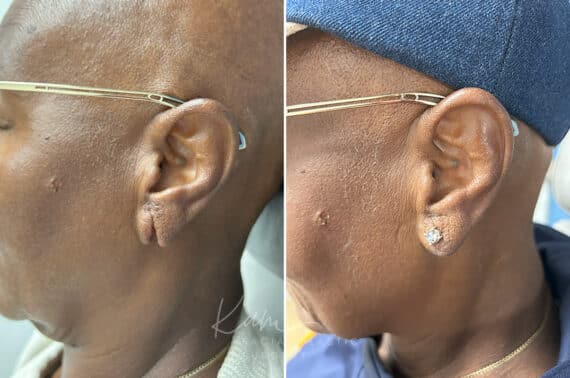 Otoplasty before and after photos in Voorhees, NJ, Patient 1926