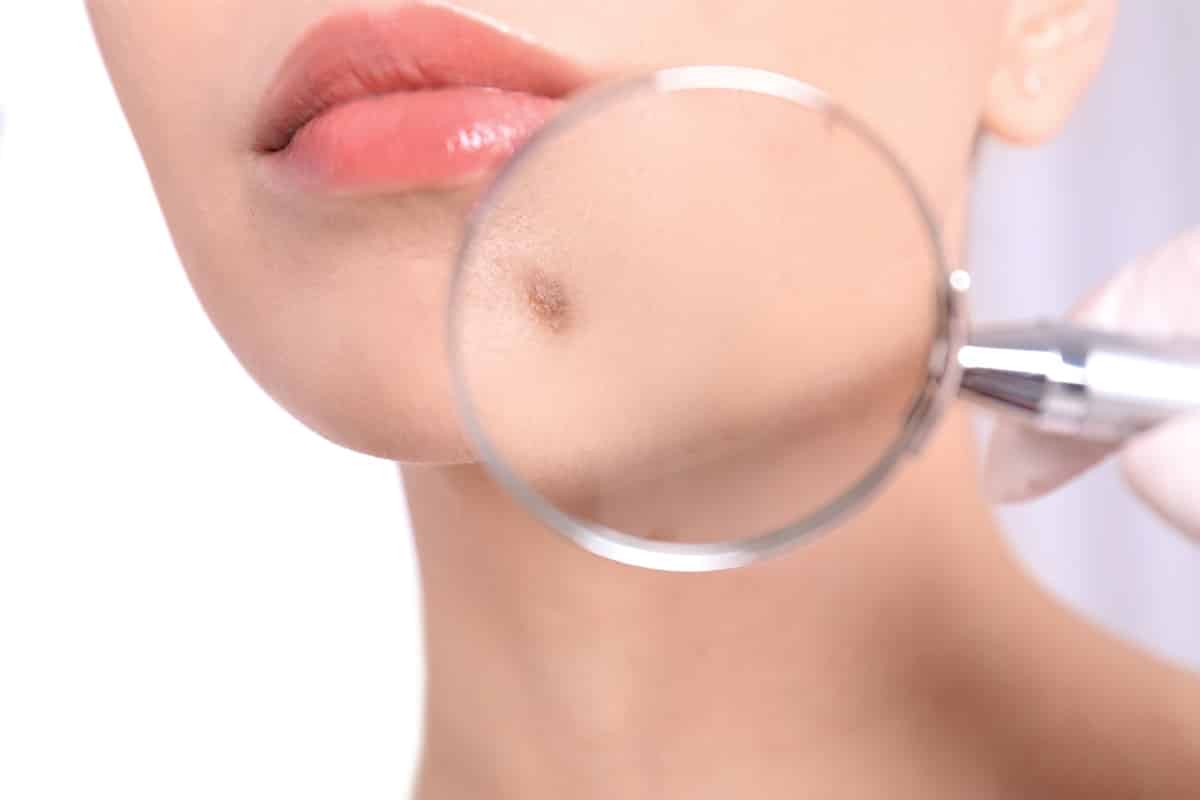 Understanding Different Skin Cancer Surgeries: Options and Outcomes