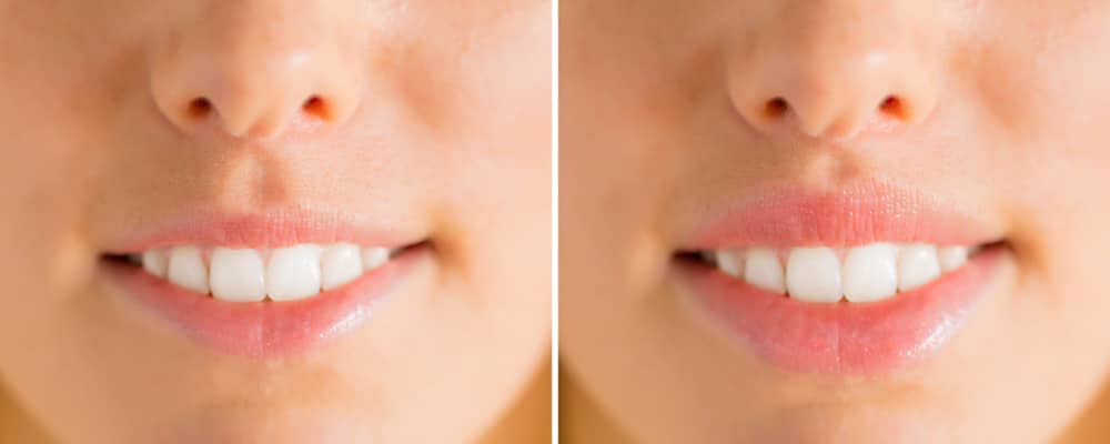 Transformative Advances in Lip Lift Cosmetic Procedures