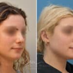 Rhinoplasty before and after photos in Voorhees, NJ, Patient 2111