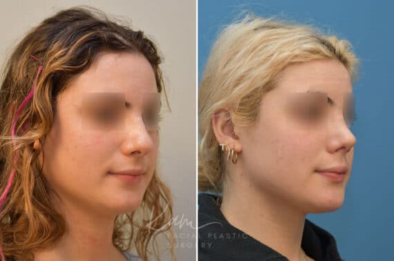 Rhinoplasty before and after photos in Voorhees, NJ, Patient 2111