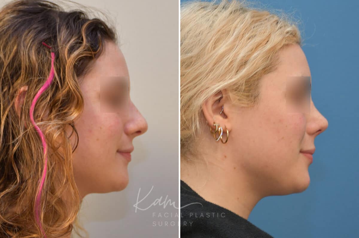 Rhinoplasty before and after photos in Voorhees, NJ, Patient 2111