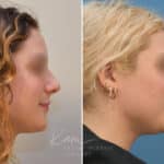 Rhinoplasty before and after photos in Voorhees, NJ, Patient 2111