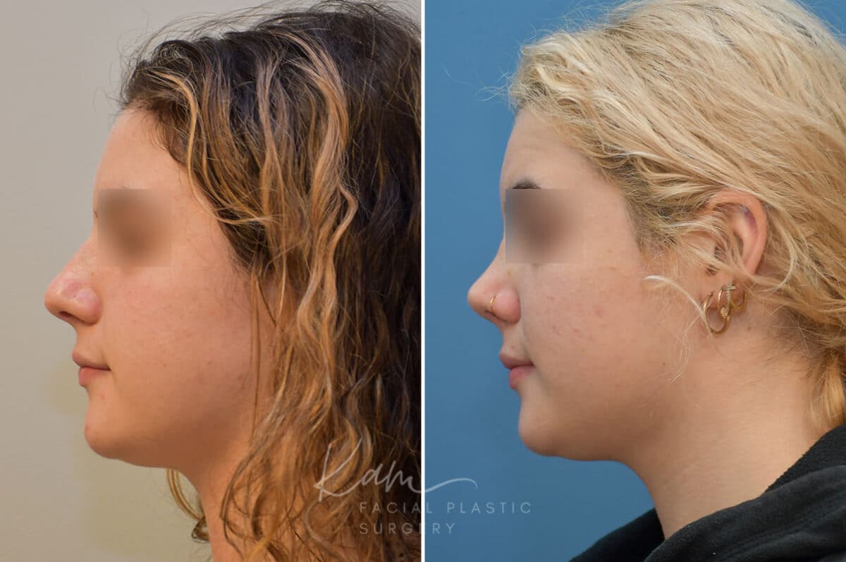 Rhinoplasty before and after photos in Voorhees, NJ, Patient 2111