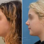 Rhinoplasty before and after photos in Voorhees, NJ, Patient 2111
