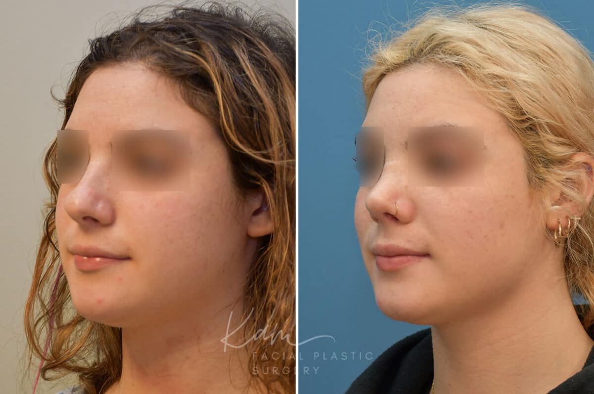 Rhinoplasty before and after photos in Voorhees, NJ, Patient 2111