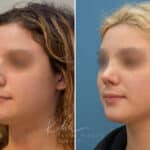 Rhinoplasty before and after photos in Voorhees, NJ, Patient 2111