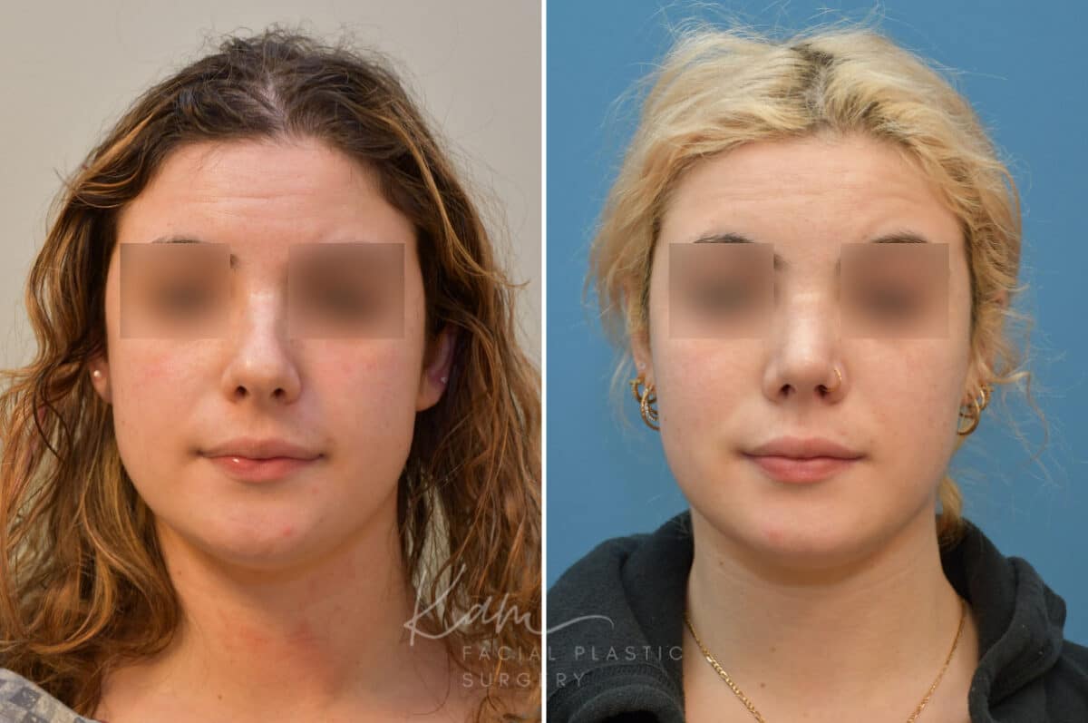 Rhinoplasty before and after photos in Voorhees, NJ, Patient 2111