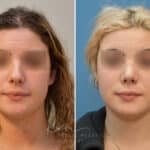 Rhinoplasty before and after photos in Voorhees, NJ, Patient 2111