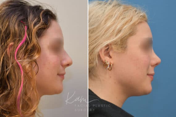 Rhinoplasty before and after photos in Voorhees, NJ, Patient 2111