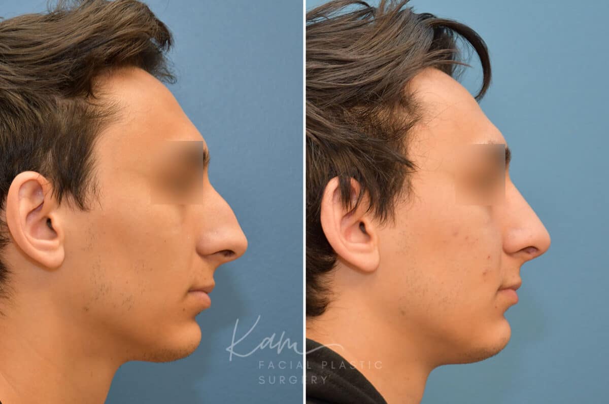 Rhinoplasty before and after photos in Voorhees, NJ, Patient 2128