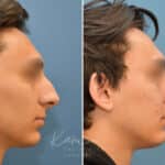 Rhinoplasty before and after photos in Voorhees, NJ, Patient 2128