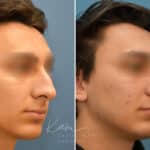 Rhinoplasty before and after photos in Voorhees, NJ, Patient 2128