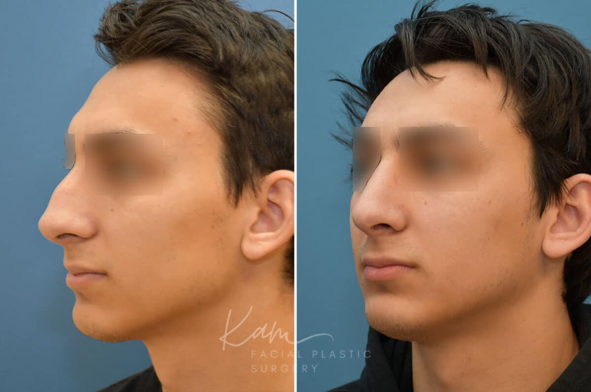 Rhinoplasty before and after photos in Voorhees, NJ, Patient 2128