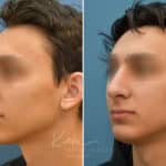 Rhinoplasty before and after photos in Voorhees, NJ, Patient 2128
