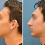 Rhinoplasty before and after photos in Voorhees, NJ, Patient 2128