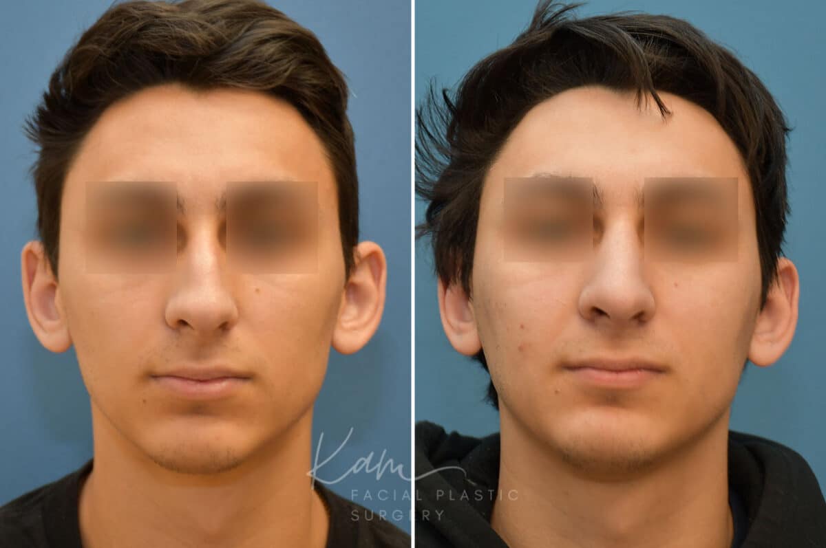 Rhinoplasty before and after photos in Voorhees, NJ, Patient 2128