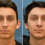 Rhinoplasty before and after photos in Voorhees, NJ, Patient 2128