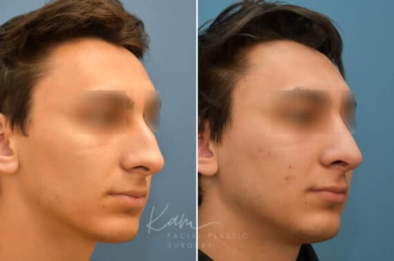 Rhinoplasty before and after photos in Voorhees, NJ, Patient 2128